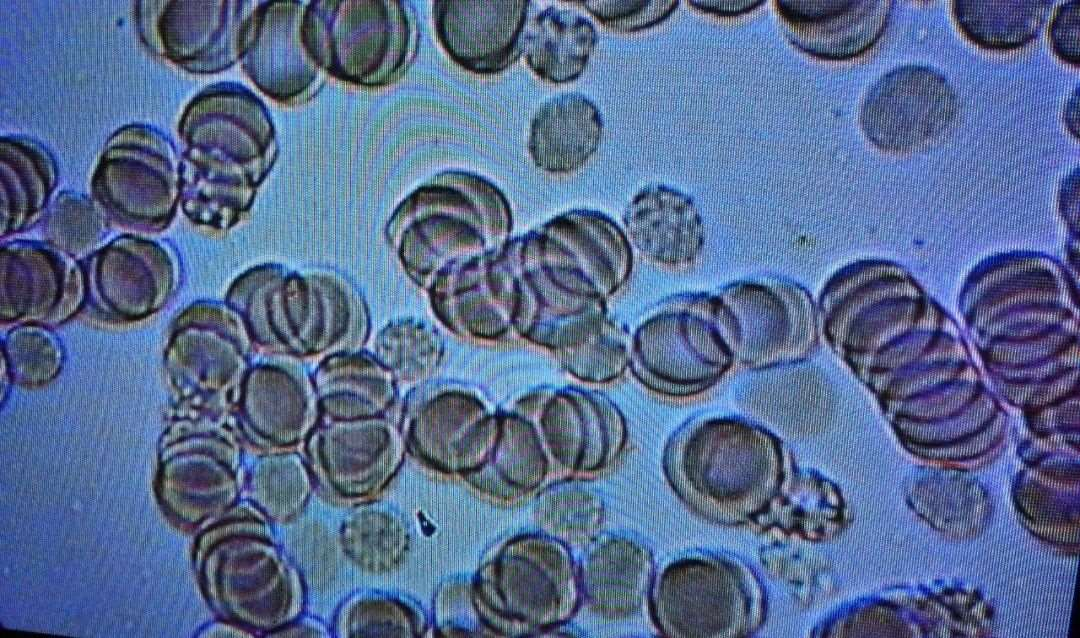 Before steaming — blood is thick with toxins, and  erythrocytes are clumped together.